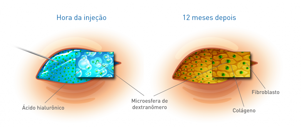 How-Deflux-Works-POR-1024x434